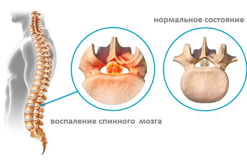 Профилактика воспаления тканей спинного и головного мозга: