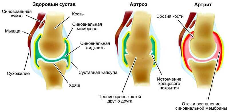 Симптомы и признаки воспаления сустава