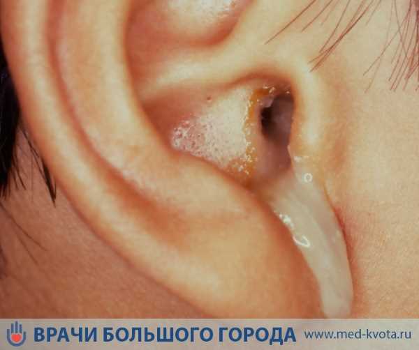 Первые признаки воспаления хрящевой ткани уха