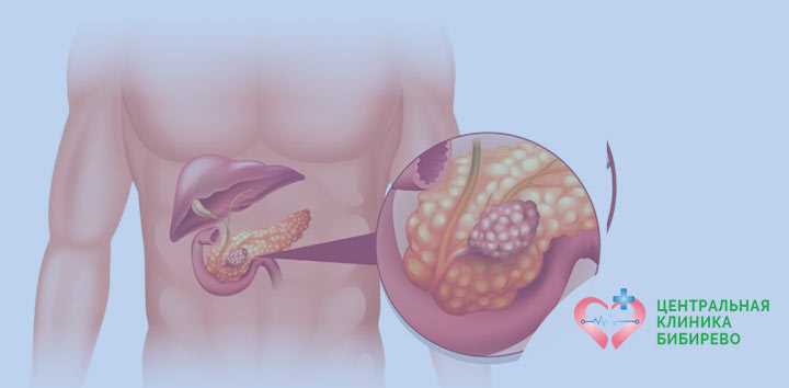 Воспаление жировой ткани в брюшной полости: чем опасно и как лечить