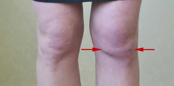 Причины возникновения болезни Гоффа-Кастира (липоартрита коленного сустава)