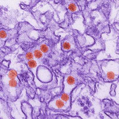 Какие симптомы сопровождают хронический вирусный гепатит В