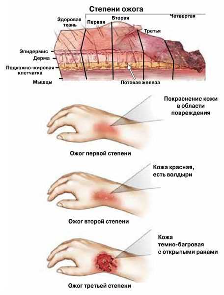 Этапы развития растяжения и разрыва связок, сухожилий и мышц